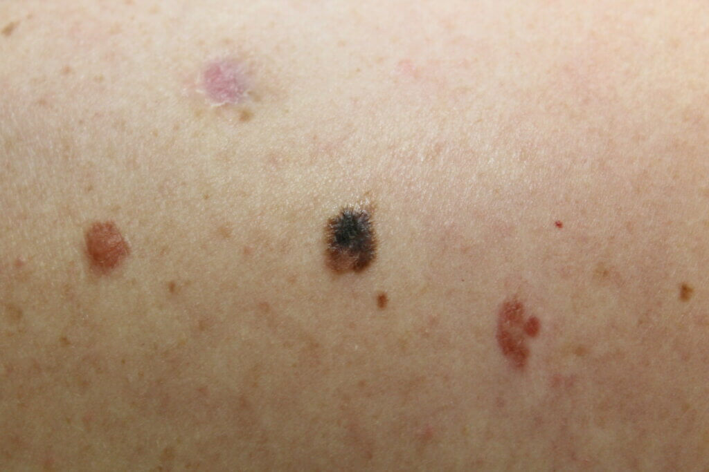 melanoma nas costas