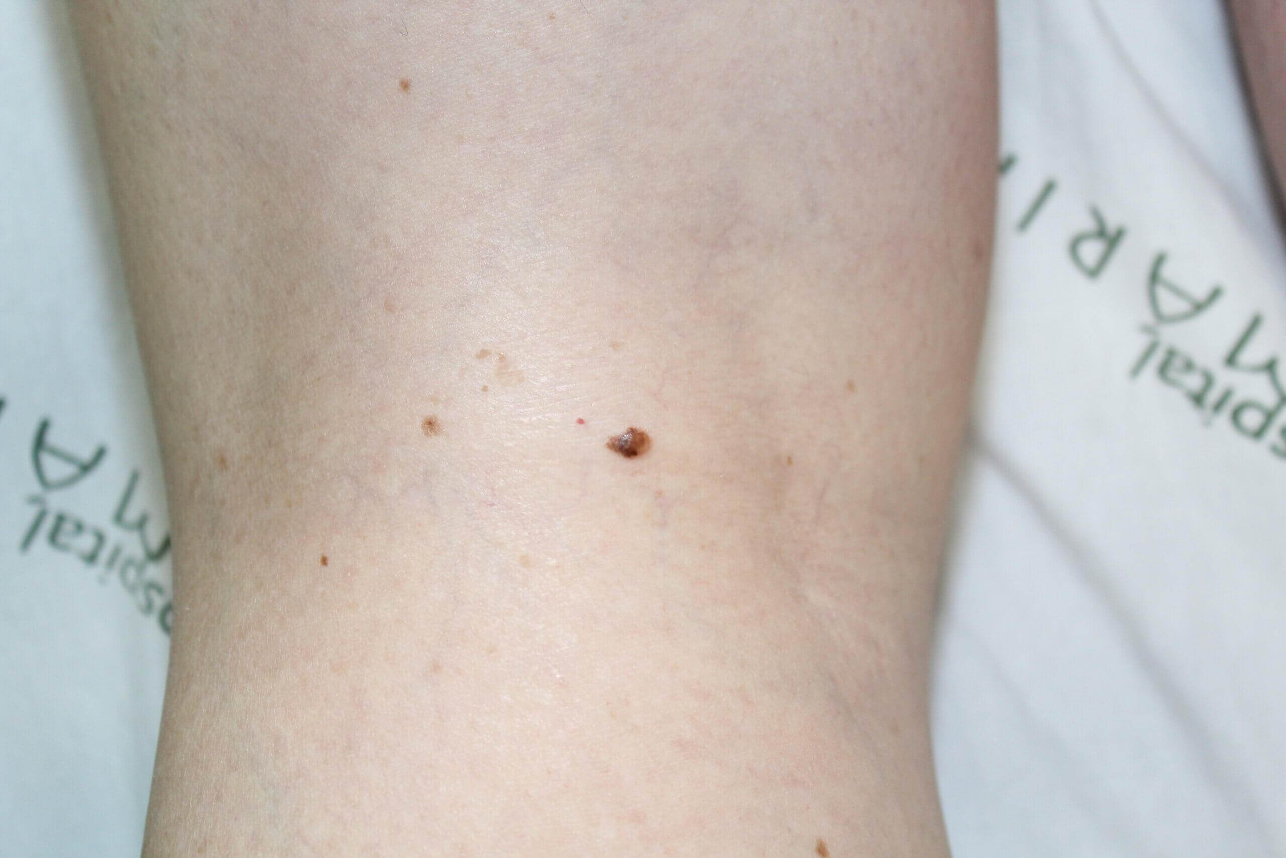 Pequeno melanoma na posterior do joelho direito