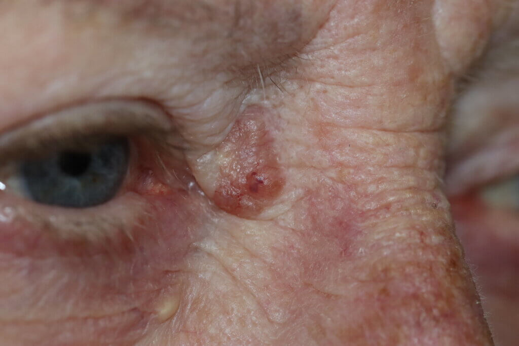 Close-up de uma lesão de carcinoma basocelular no canto interno do olho direito, apresentando bordas bem delimitadas e coloração rosada.