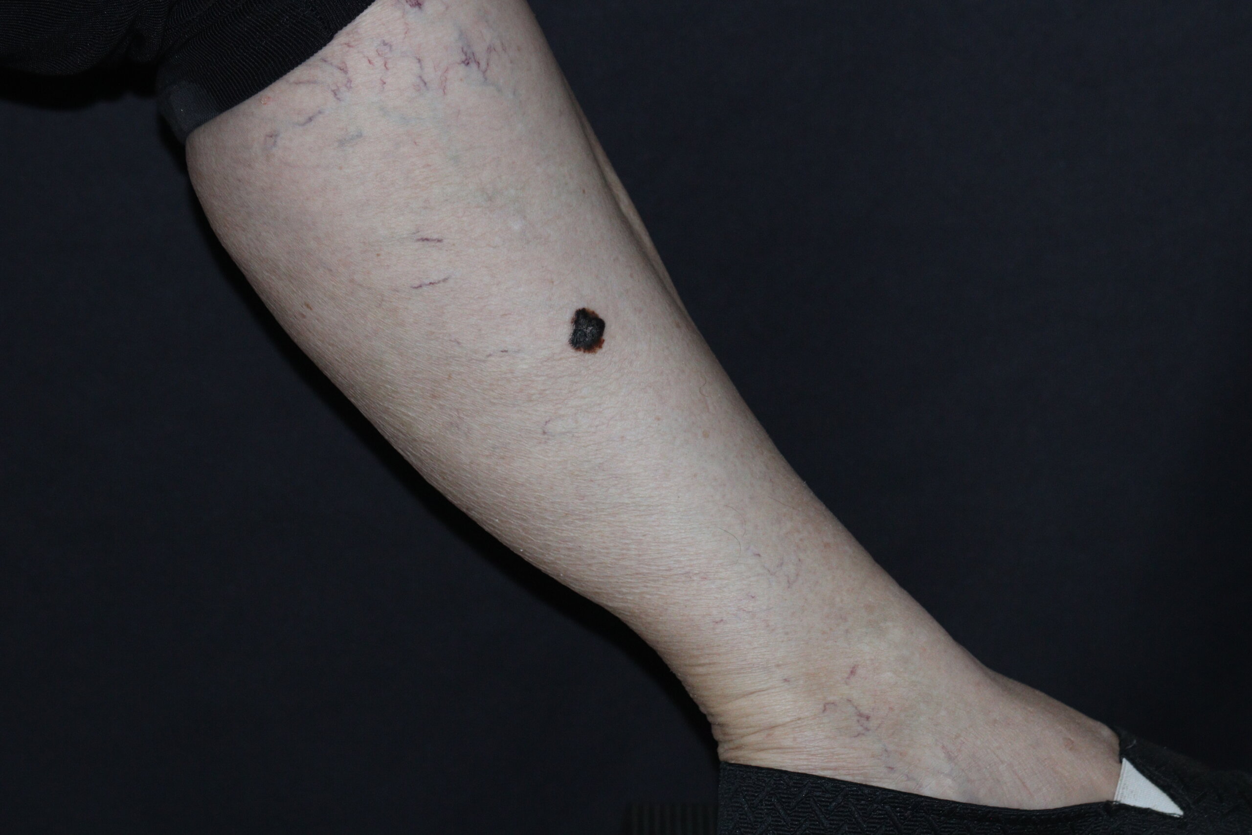 Imagem de uma perna feminina com uma lesão pigmentada escura e irregular, característica sugestiva de melanoma. A lesão está localizada na parte anterior da perna, destacando uma área comum de desenvolvimento desse tipo de câncer em mulheres.