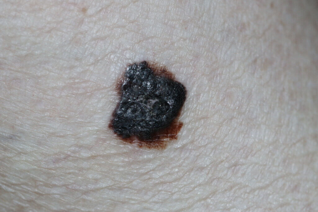  Close-up de um melanoma na perna, mostrando uma lesão com bordas assimétricas, coloração escura e áreas de variação de pigmentação, típica de um tumor maligno de pele.