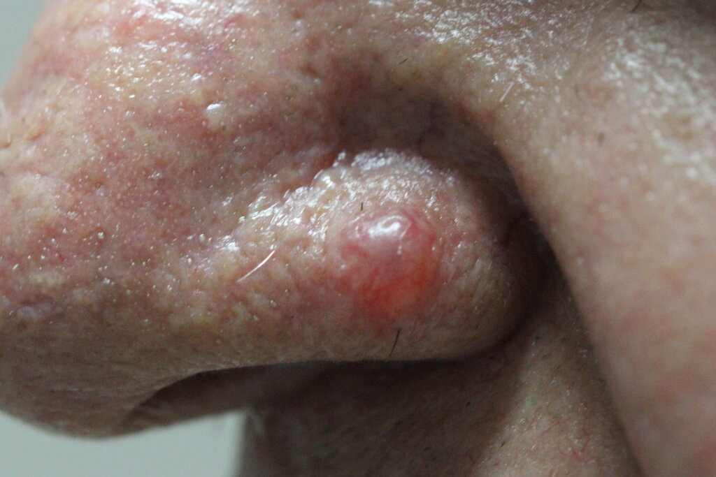 Imagem de um carcinoma basocelular na asa nasal de um paciente. A lesão apresenta-se como uma pápula rosada, brilhante e bem delimitada, com características sugestivas de neoplasia cutânea.