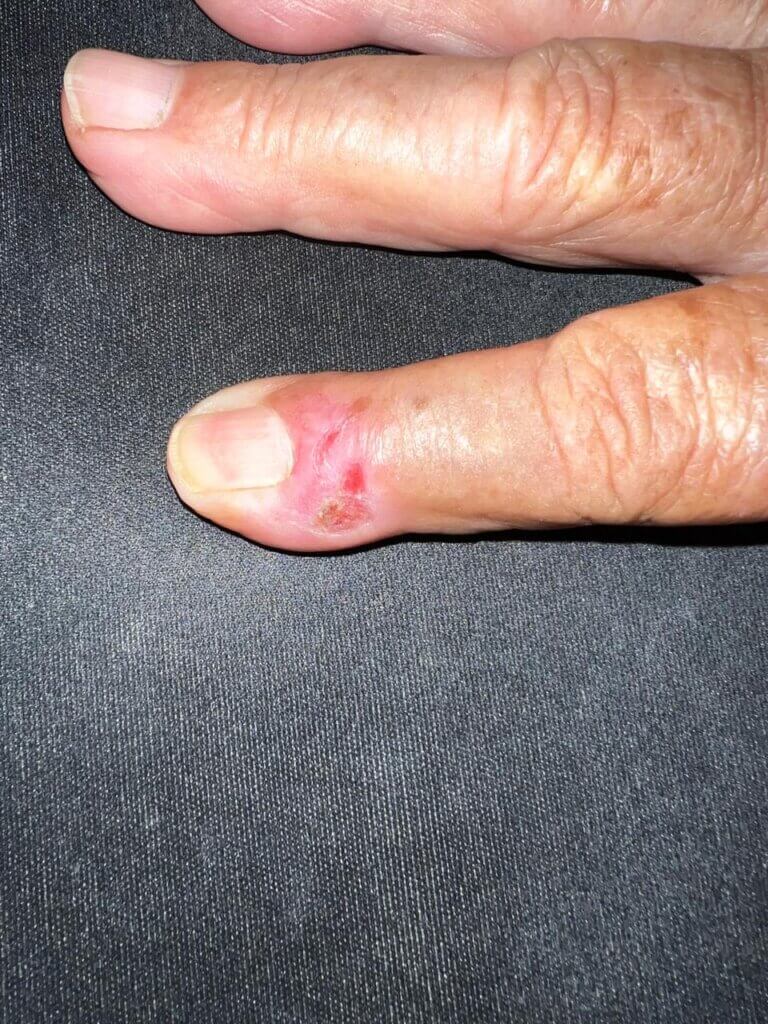 Lesão avermelhada e ulcerada na base da unha de um dedo da mão, com descolamento parcial da lâmina ungueal e aspecto inflamado da pele ao redor. A imagem ilustra um caso suspeito de carcinoma espinocelular da unidade ungueal.