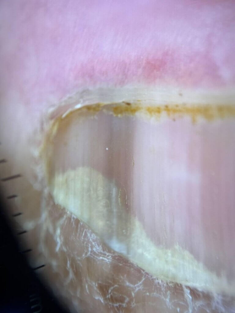 Imagem dermatoscópica em close do polegar esquerdo, mostrando a lâmina ungueal com faixas longitudinais de coloração variável e assimétrica, além de pigmentação irregular na região periungueal externa.
