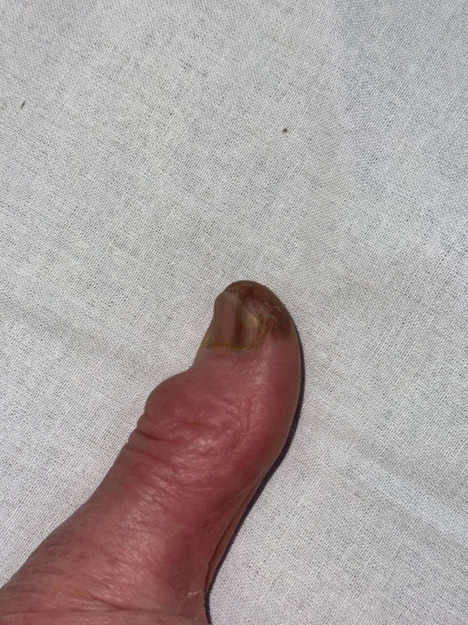 Fotografia em close do polegar da mão esquerda. A unha apresenta uma faixa pigmentada escura e irregular, estendendo-se até a ponta do dedo. Há também escurecimento na polpa digital. A imagem sugere alteração ungueal suspeita para melanoma in situ