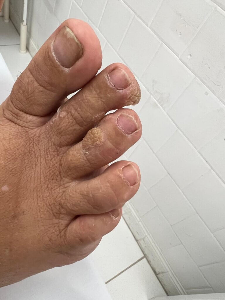 Pé com lesões hiperqueratóticas e irregulares ao redor das unhas dos dedos, mostrando espessamento da pele e aspecto verrucoso nas áreas periungueais.
Imagem de arquivo pessoal do autor.