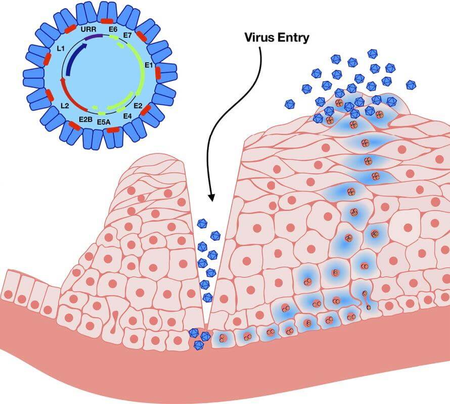 Ilustração mostrando o HPV entrando por uma fissura na pele e infectando células da camada basal da epiderme, com esquema da estrutura do vírus no canto superior esquerdo.
Fonte: Zayats R, Murooka TT, McKinnon LR. Front Cell Infect Microbiol. 2022.