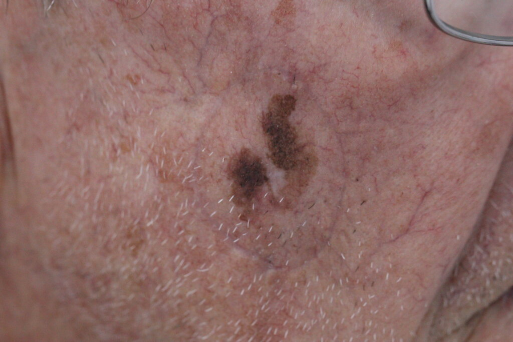 Lentigo maligno na face de paciente idoso, apresentando placa pigmentada irregular, assimétrica, com variação de tons castanho-escuros e limites mal definidos, em área de fotodano crônico.