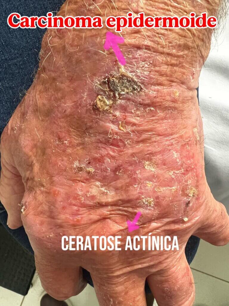 Imagem do dorso de uma mão idosa com múltiplas ceratoses actínicas, apresentando áreas avermelhadas e descamativas. Uma seta destaca uma lesão espessa e crostosa compatível com carcinoma espinocelular, e outra seta aponta uma ceratose actínica.