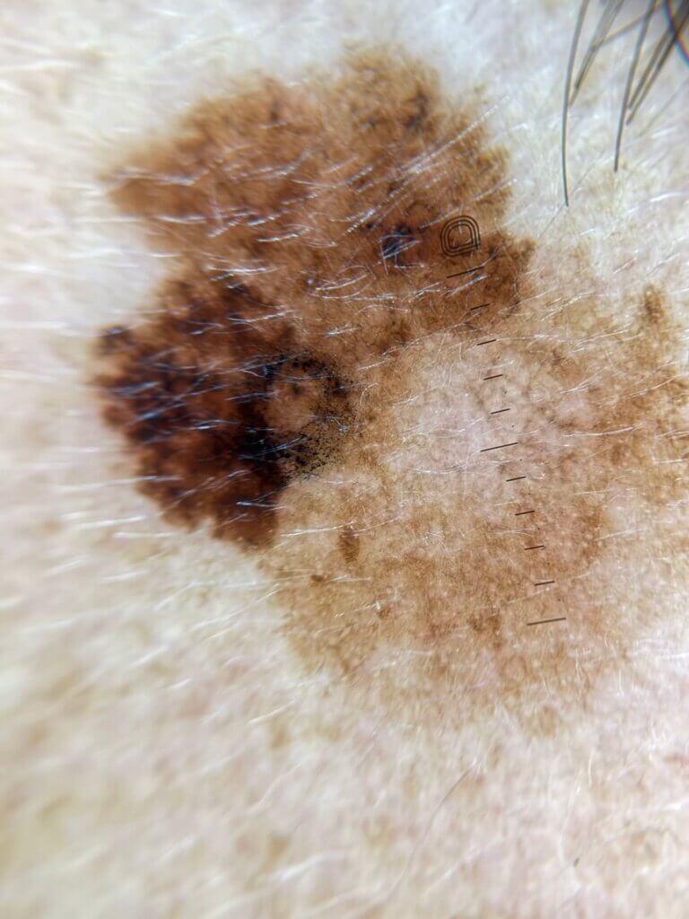 Dermatoscopia de melanoma inicial: critérios do ABCDE