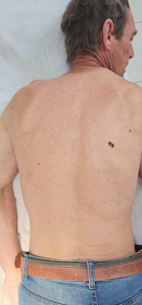 Melanoma nas costas