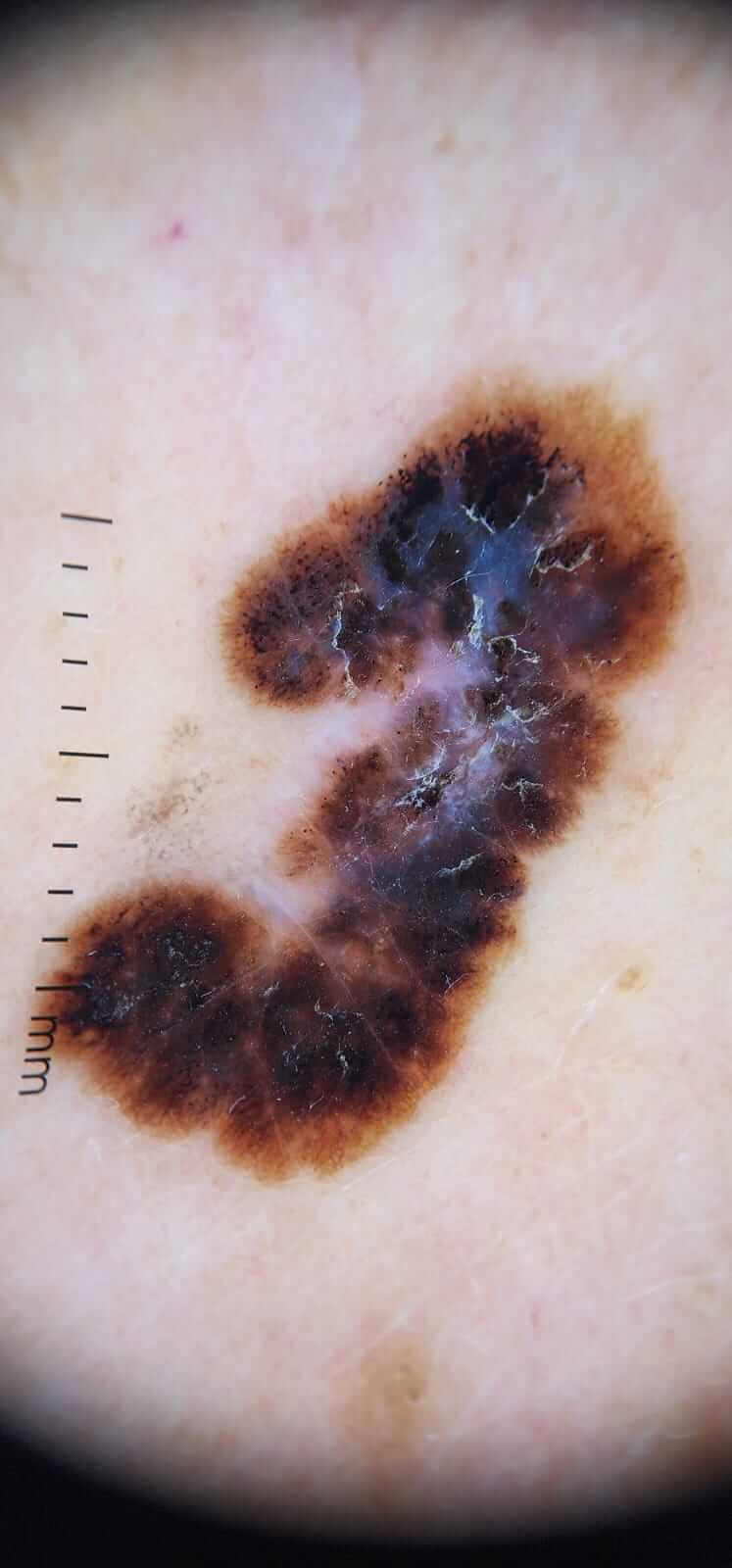 dermatoscopia de melanoma
