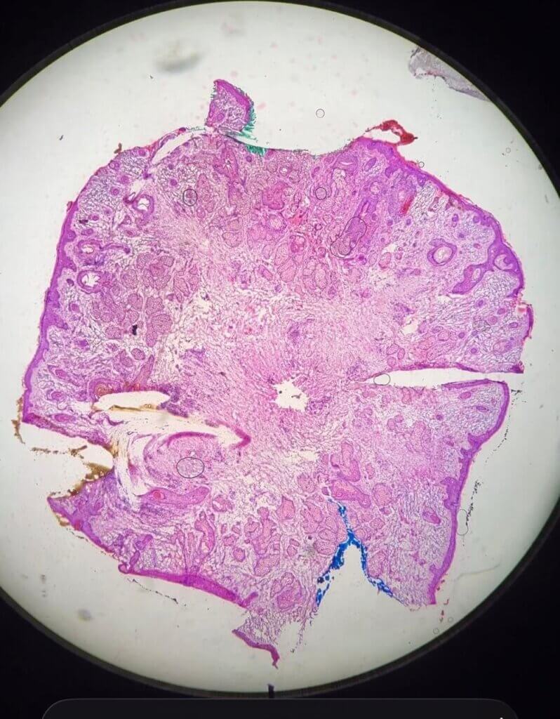 histopatologia transoperatória na cirurgia micrográfica de mohs