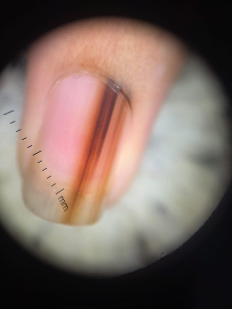 Imagem dermatoscópica de unha mostrando faixa pigmentar longitudinal escura, irregular, com múltiplos tons de marrom e preto, variação de espessura entre as linhas e diferença de coloração entre a base e a extremidade da unha, achados sugestivos de melanoma subungueal.