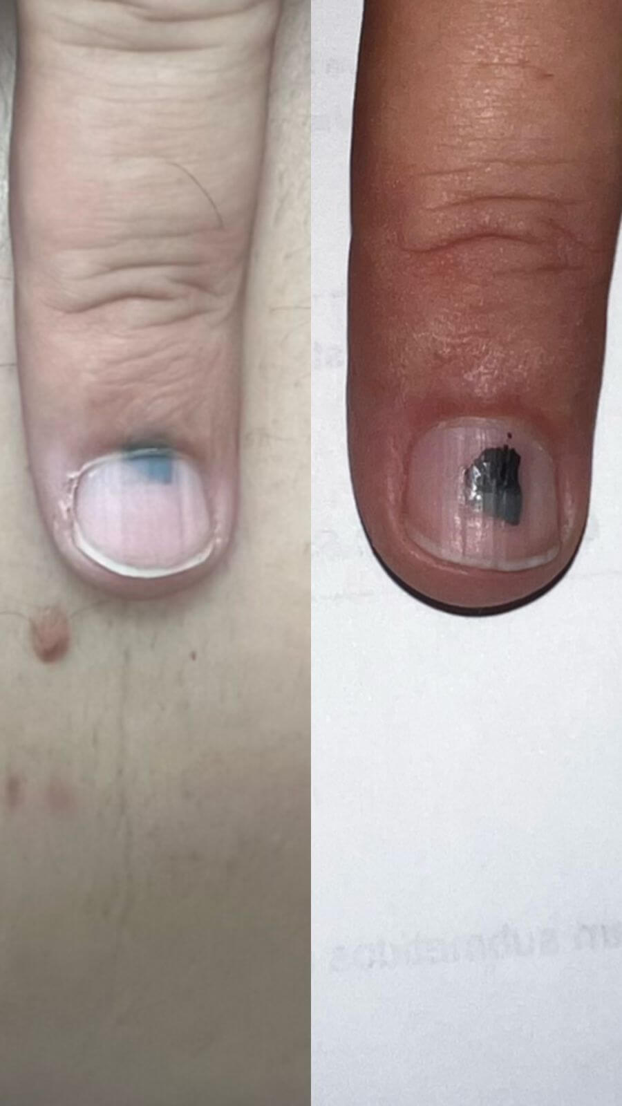 Fotografia clínica de unha do dedo da mão apresentando hematoma subungueal, com mancha escura localizada sob a lâmina ungueal, sem acometimento da cutícula, ilustrando aspecto benigno e evolução compatível com hematoma e não melanoma.