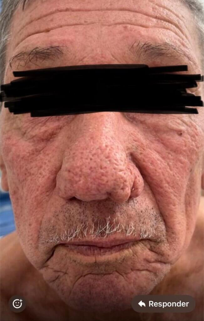 Nariz com rinofima avançada, apresentando espessamento da pele, aumento nodular e poros dilatados, característicos da forma grave da rosácea fimatosa.