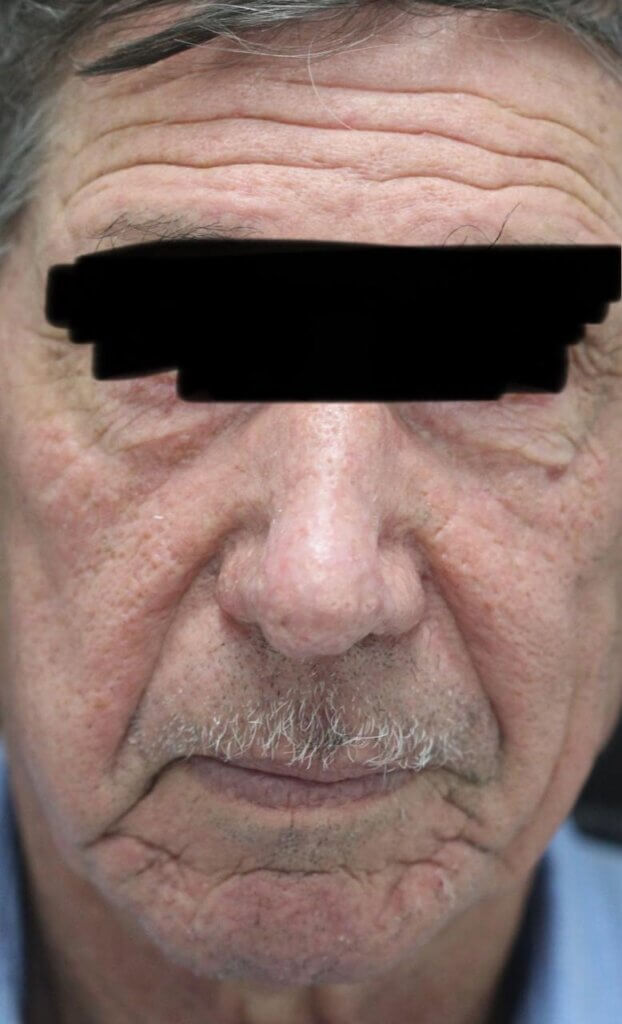 Nariz após tratamento cirúrgico da rinofima, seis meses de evolução, com melhora do contorno nasal, redução do volume e superfície cutânea mais regular.