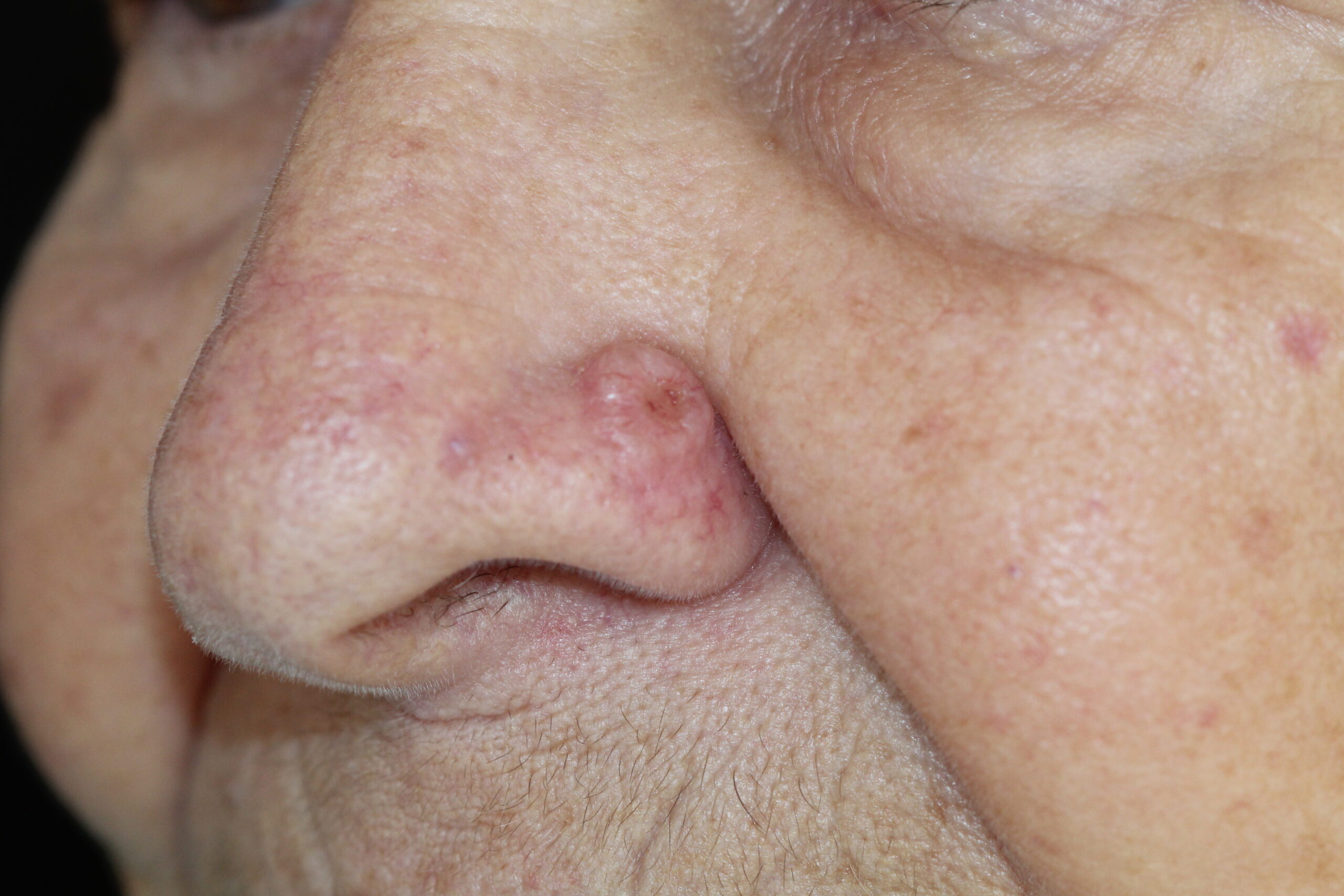 Sintomas De Carcinoma Basocelular Como Identificar A Lesão Na Pele Antes Que Avancee