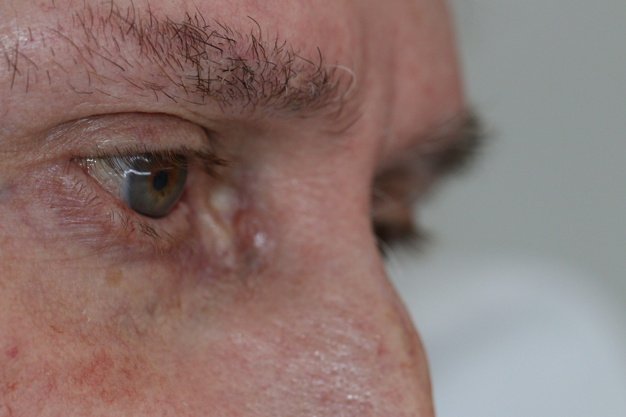Quando-Carcinoma-Basocelular-E-Grave-Drtimotiodorn — Quando o Carcinoma Basocelular É Grave: Sinais de Alerta, Subtipos Agressivos e Riscos de Invasão