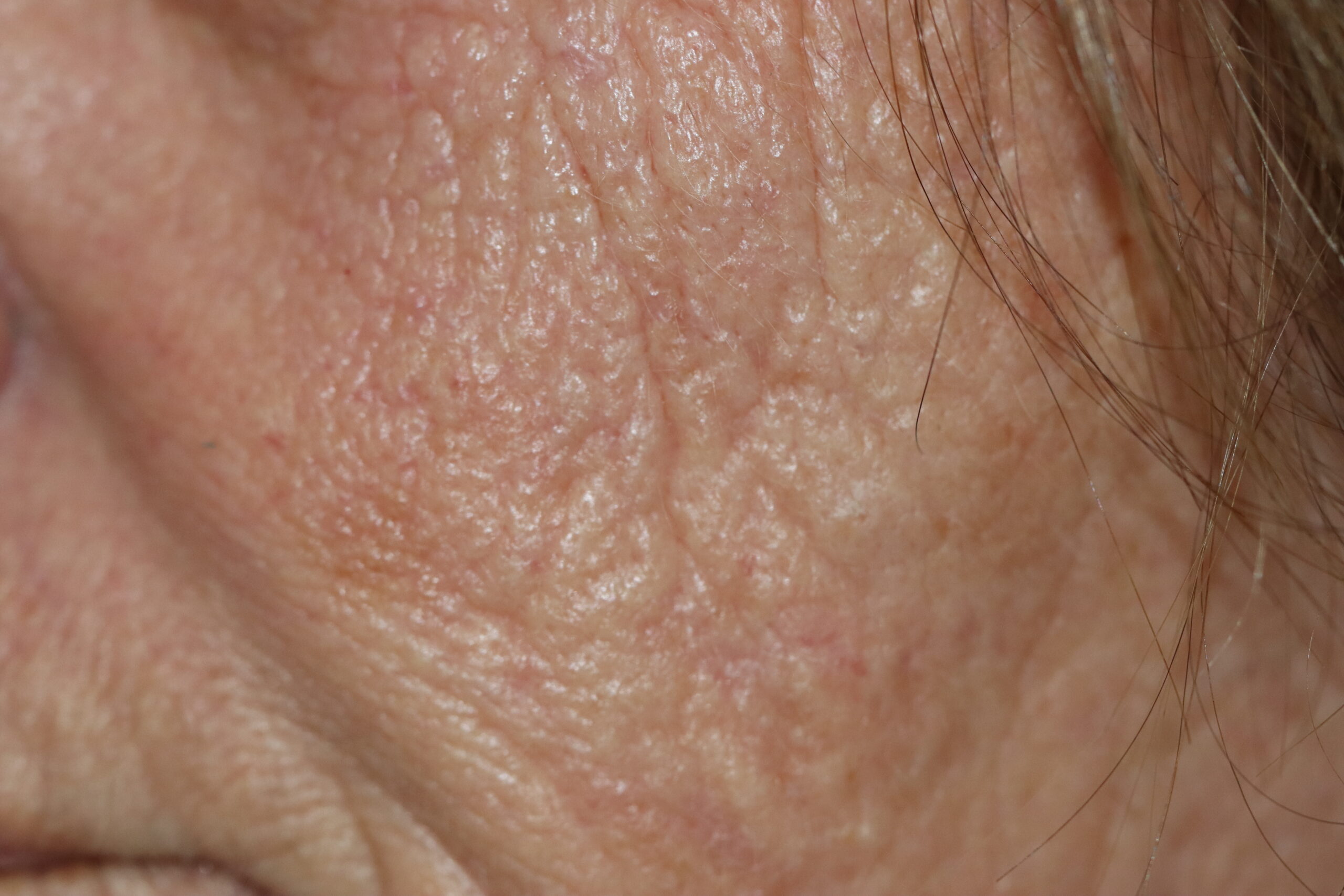 Close-up de rugas finas e linhas de expressão ao redor dos olhos em pele com sinais de envelhecimento