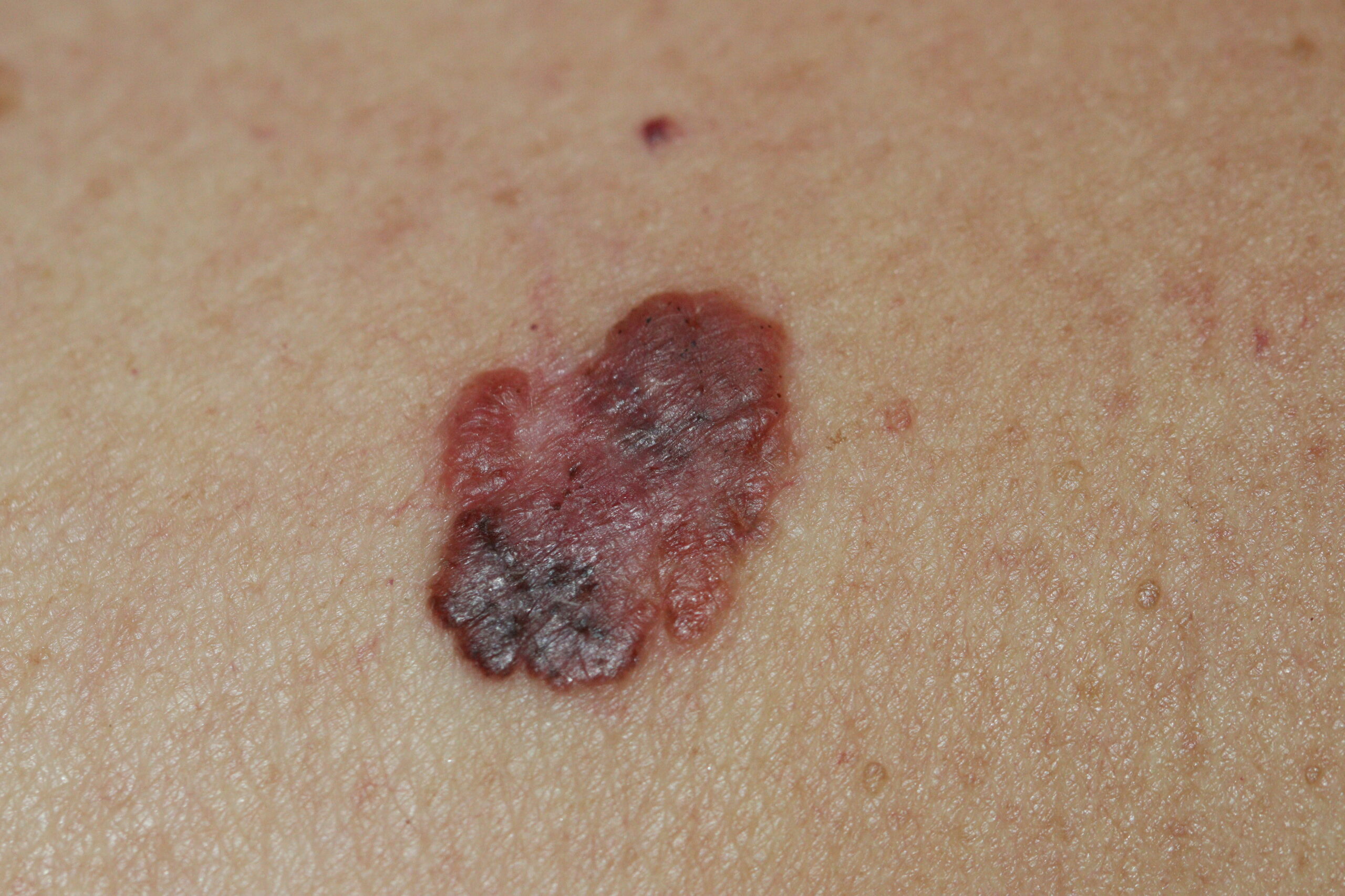 Melanoma com assimetria, bordas irregulares e variação de coloração, características sugestivas de câncer de pele que requer avaliação dermatológica.