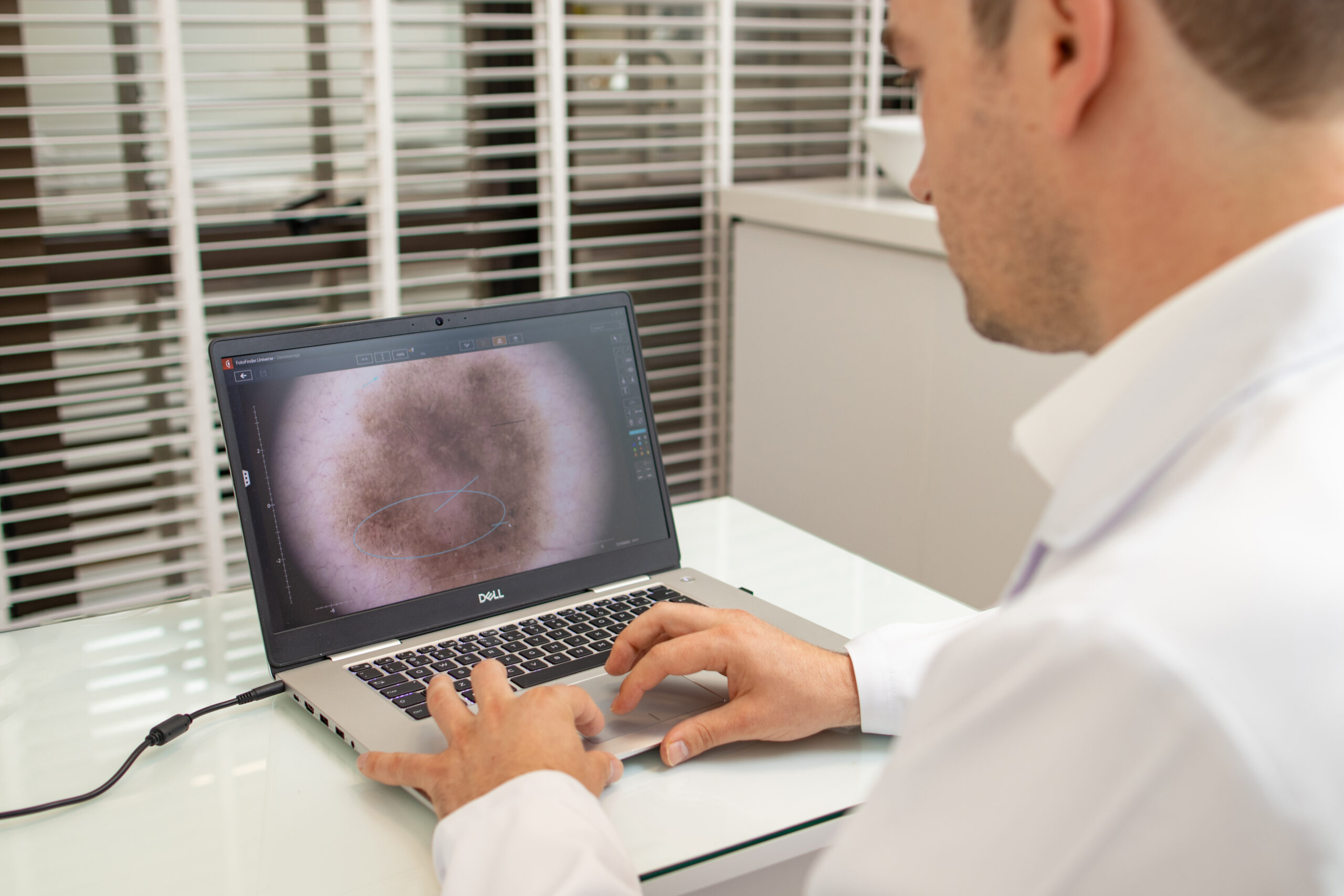 Dermatologista analisa imagem dermatoscópica de lesão cutânea em computador para planejamento da cirurgia de Mohs.