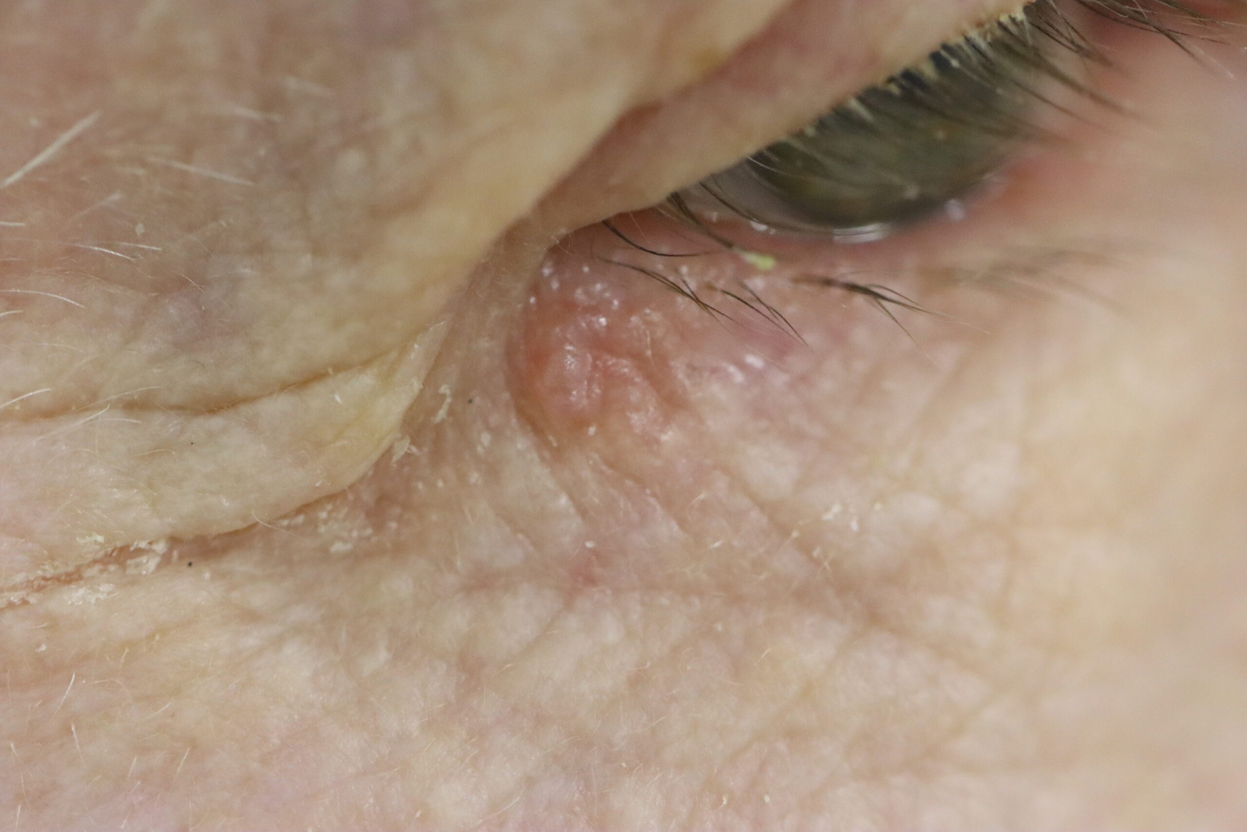 Carcinoma basocelular na pálpebra inferior, próximo ao canto interno do olho, antes da cirurgia de Mohs.