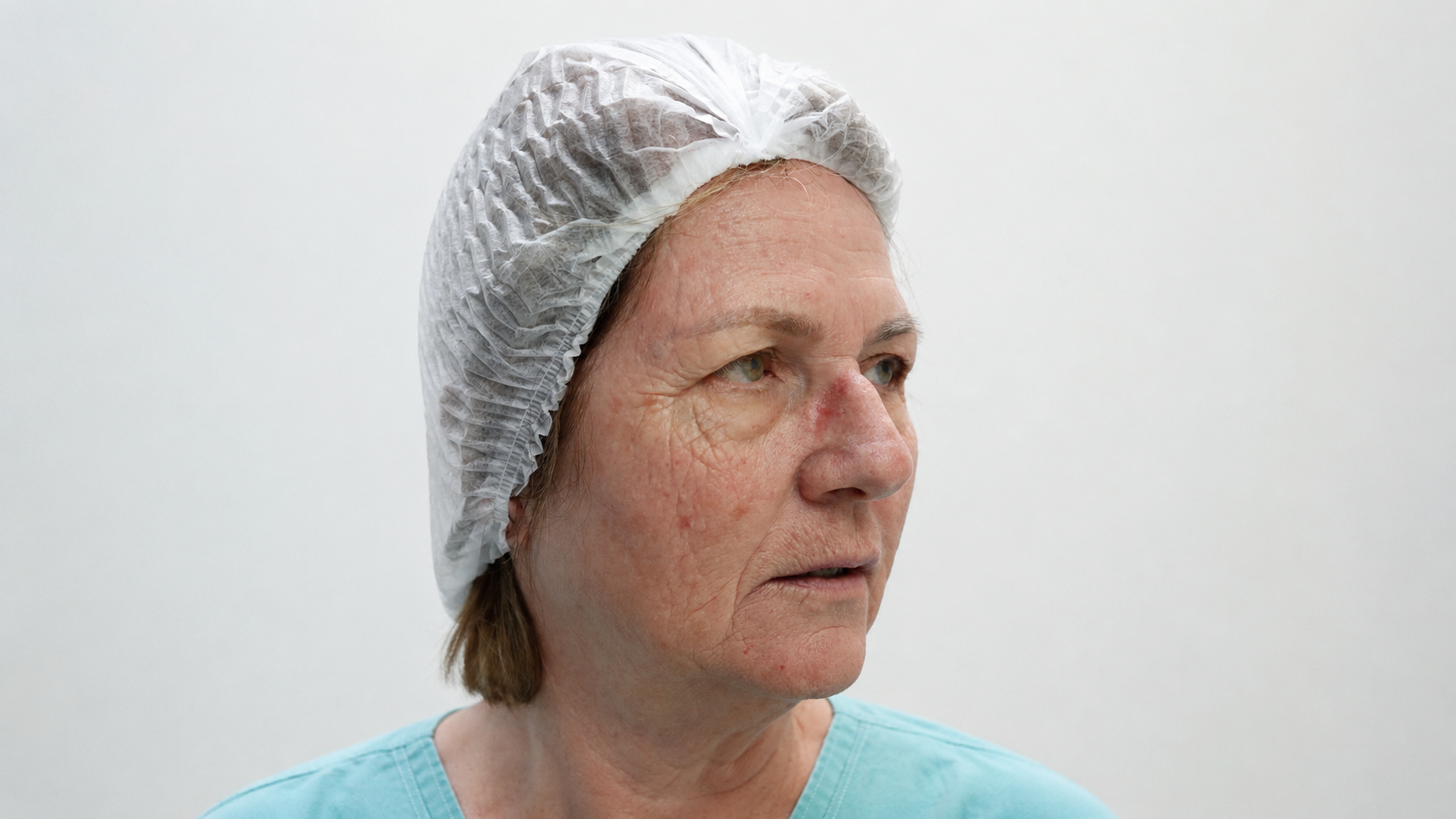 Paciente em vista lateral com lesão cutânea avermelhada no dorso do nariz, preparada para avaliação dermatológica.