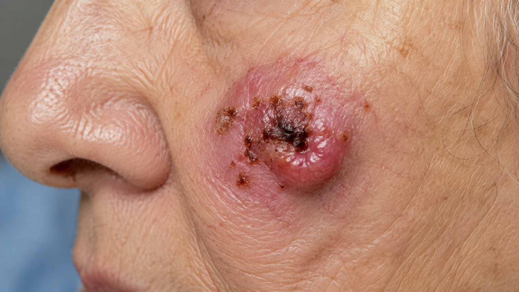 Lesão de carcinoma basocelular recidivado na face, próxima ao nariz, com área elevada, avermelhada e ulcerada.